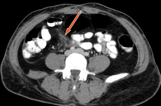 LESION MESENTÉRICA POR CINTURÓN DE SEGURIDAD